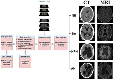 Systematic and Comprehensive Automated Ventricle Segmentation on Ventricle Images of the Elderly Patients: A Retrospective Study